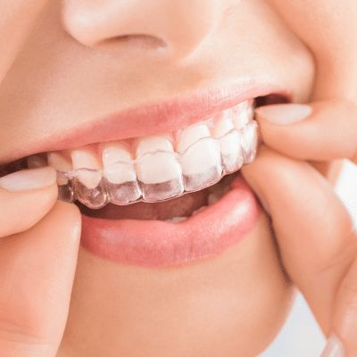 Aligners_ Invisalign - How It Works and Benefits.jpg