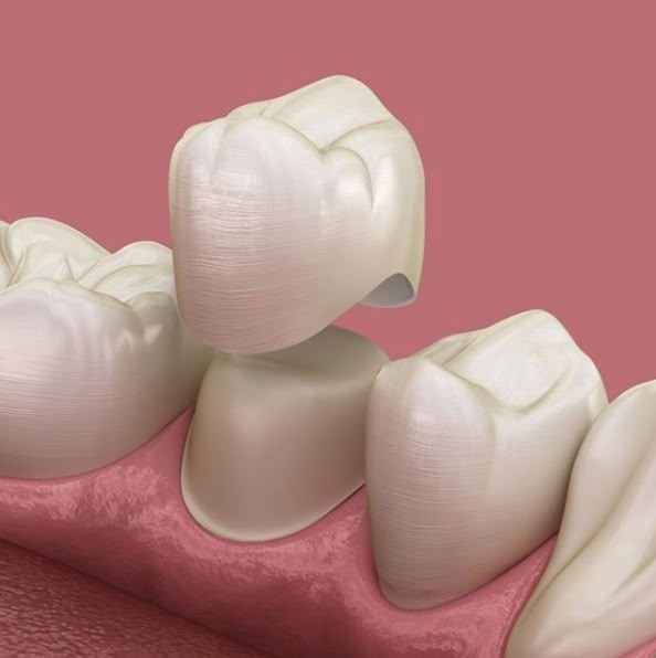 Dental crown_ Affordable dental services.jpg
