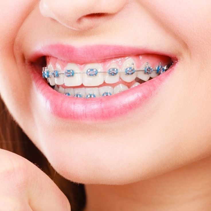 Invisalign Braces.jpg