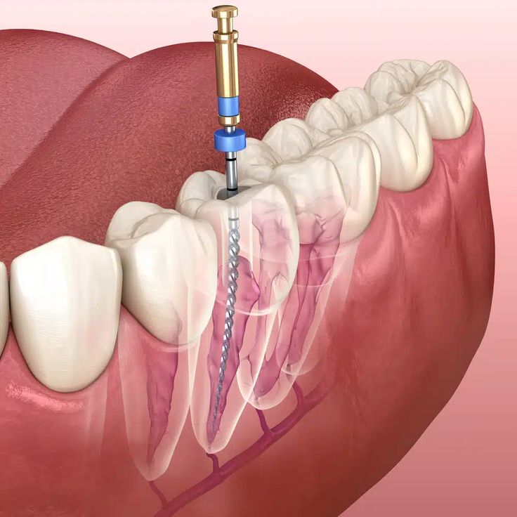 Root Canal.jpg
