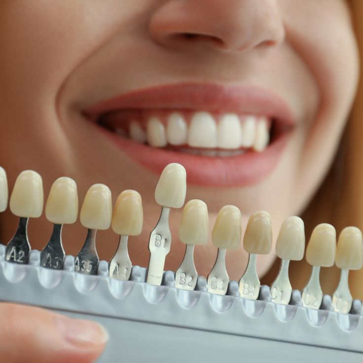 dental veneers.jpg