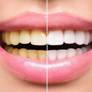 teeth whitening (1).jpg