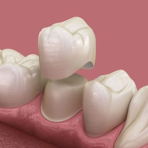 Dental crown_ Affordable dental services.jpg