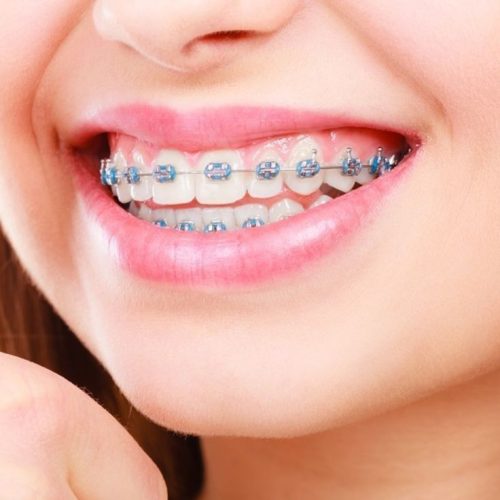 Invisalign Braces.jpg
